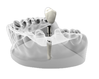 Impianti Dentali Caserta